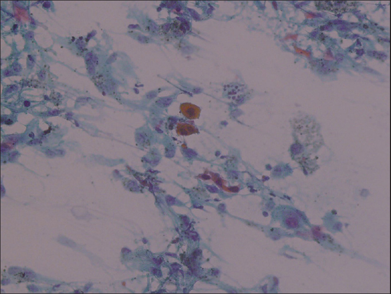 Cytoplasmic eosinophilia, typical for squamous cell carcinoma (PAP, ×20)