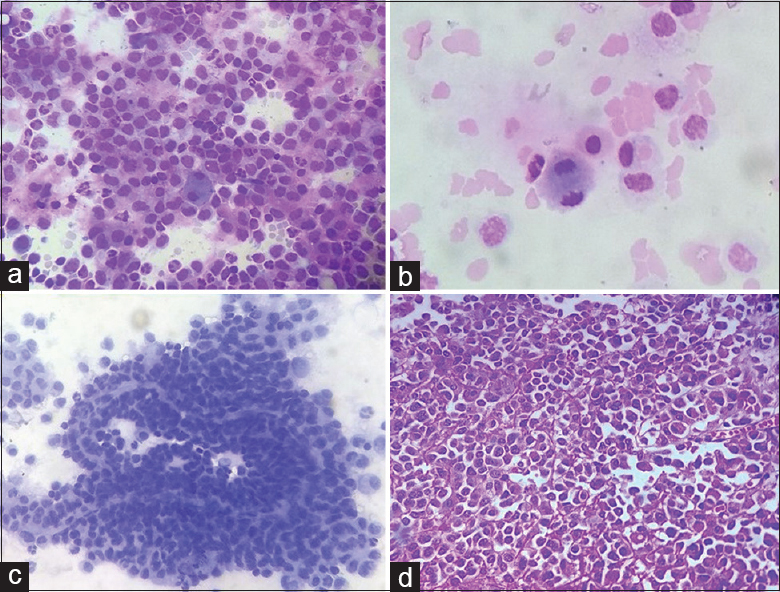 malignant cells in csf