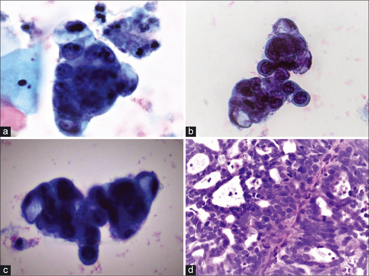 Hyperchromatic-crowded groups (a and b) adjacent to benign squamous cells (PAP, ×40), (c) hyperchromatic-crowded group with intracytoplasmic mucin (PAP, ×40), (d) The biopsy specimen showed cribriform/microacinar architecture with confluent neoplastic glands (H and E, ×40).