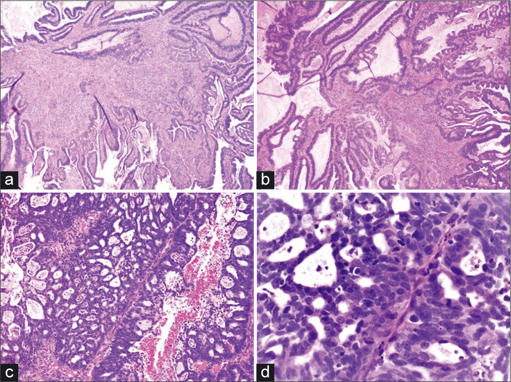 (a and b) Angulated, fragmented, infiltrative, and irregularly shaped glands with a conspicuous desmoplastic reaction (H and E, ×4 and ×10). (c and d) Malignant fused glands with cribriform architecture and a neutrophilic infiltrate (H and E, ×10 and ×40).