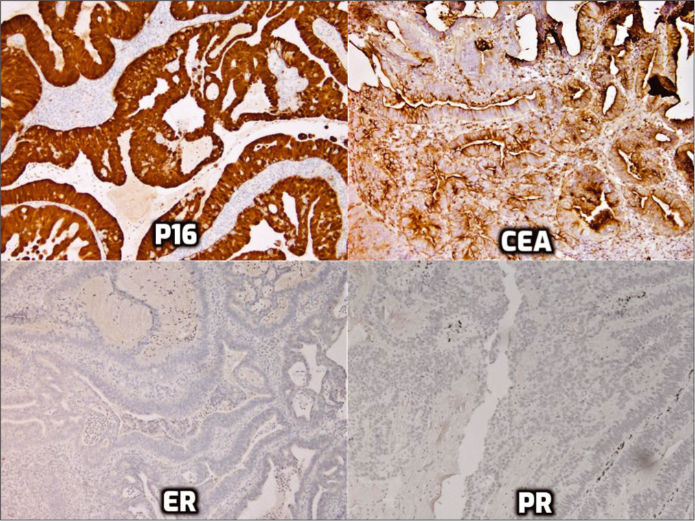 Immunohistochemistry for p16, monoclonal carcinoembryonic antigen, estrogen receptor, and progesterone receptor.