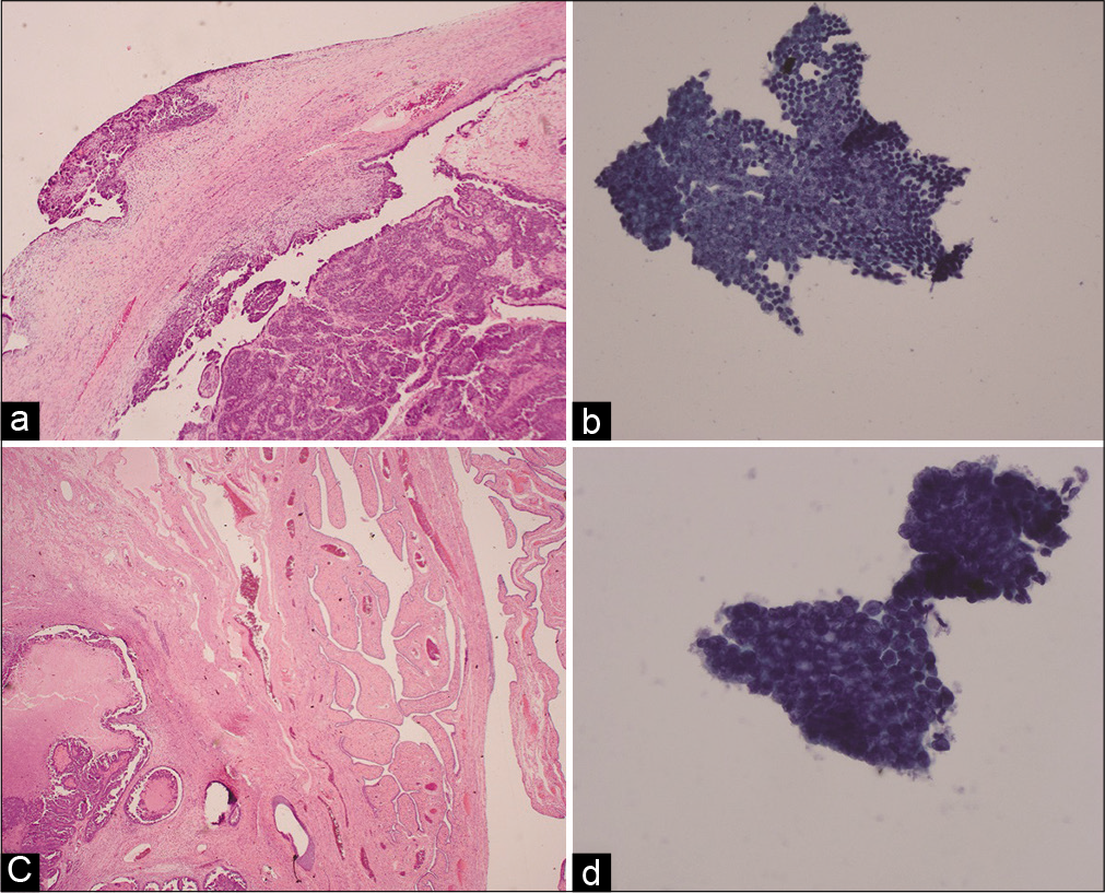 Histology (a and c) and cytology (b and d) images from a Stage IV high grade serous ovarian cancer case. (a) Histology of the right ovary reveals surface tumor. (b) Right tube cytology image showing a spectrum of cell types ranging from 3-dimensional clustering to flat sheet. (c) Histology of the right fallopian tube reveals serous carcinoma. (d) Right tube cytology image showing 3-dimensional clustering with loss of the normal three cell types and marked nuclear atypia.