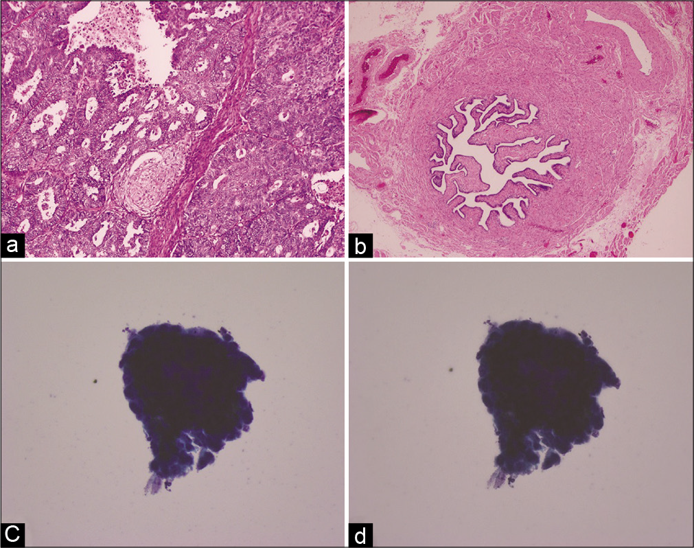 Histology (a and b) and cytology (c and d) images from a Stage IA clear cell carcinoma (right ovary) case. (a) Histology of the right ovary reveals tumor. (b) Histology of the right fallopian tube does not show malignancy. (c and d) Cytology images of the right fallopian tube at two different focal planes show 3-dimensional cluster with atypia.