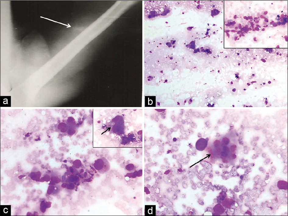 Plain radiograph demonstrates a soft-tissue lesion with specks of calcification (arrow) and intact underlying cortices of the humerus (a). Fine-needle aspiration smears showing low cellularity (b, Giemsa, ×10) and few groups of round to polygonal cells in the inset (Giemsa, ×40). Prominent nuclear pleomorphism (c, Giemsa, ×40), better seen in inset (arrow) and occasional multinucleated osteoclast-like giant cell marked by arrow (d, Giemsa, ×40) are seen.