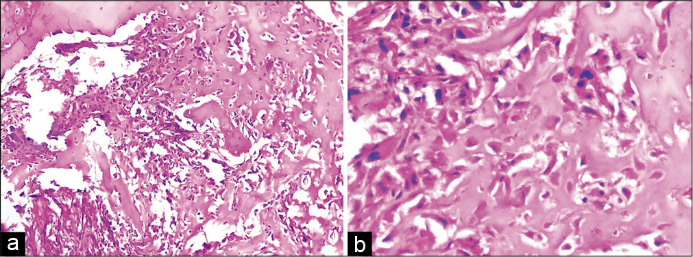 Histological photomicrographs showing a cellular tumor (a, H&E, ×10) with prominent osteoid production (b, H&E, ×40). The osteoid is directly in contact with the pleomorphic tumor cells.