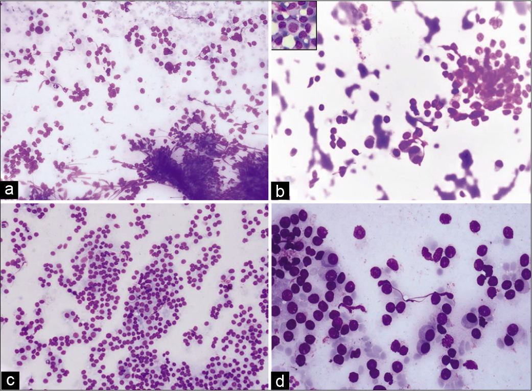 (a) FNA smears of scalp swelling showing clusters and dispersed round cells (Giemsa, ×100). (b) FNA smears of scalp swelling showing uni- and binucleate cells with eccentric nuclei (Giemsa, ×400), inset: Plasma blast-like cell with dispersed chromatin and moderate cytoplasm. (c) Squash cytology smears of parietal mass showing sheets and scattered oval cells (Giemsa, ×100). (d) Squash cytology smears of parietal mass showing plasmacytoid cells with abundant cytoplasm and eccentrically placed nuclei (Pap, ×400).