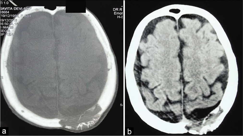 (a) T1W MRI of the brain showing a well-defined, extra-axial, isointense lesion in the left parietal region. (b) The same lesion is heterogeneously hyperintense on T1W gadolinium-enhanced MRI.