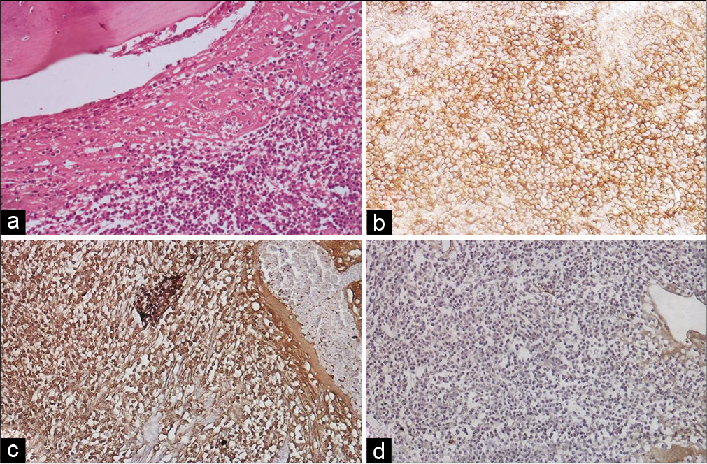 (a) Tissue sections from parietal mass showing sheets of plasma cells involving the bone (H&E, ×100). (b) Plasma cells showing diffuse membranous positivity for CD 138 (×100). (c) Nuclei of plasma cells showing diffuse kappa positivity (×100). (d) Nuclei of plasma cells negative for lambda (×100).