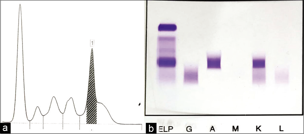(a) Serum protein electrophoresis: Densitometric tracing showing M-spike. (b) Serum protein electrophoresis: Gel picture showing M-band.