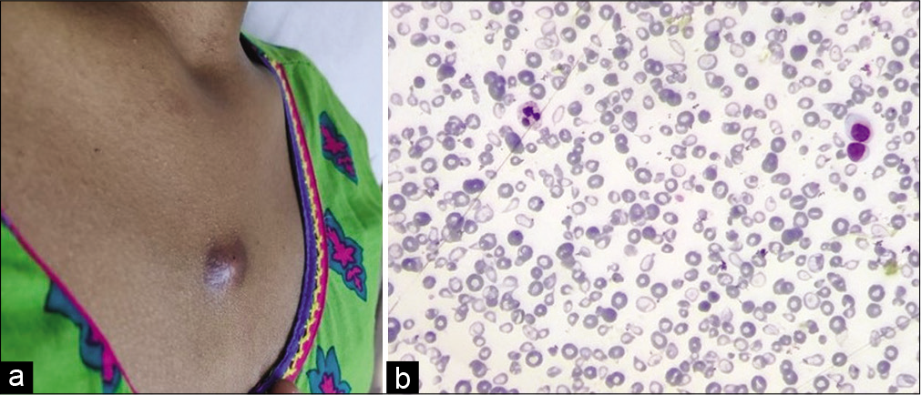 (a) A reddish-brown nodular midline subcutaneous swelling in the upper chest measuring 0.8 × 0.8 cm, (b) Peripheral smear showing marked anisopoikilocytosis with microcytes, tear drop cells, target cells, and hypochromia (200×, Leishman stain).