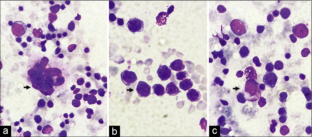 (a) Megakaryocyte (arrow) (1000×, Giemsa stain), (b) Erythroid Island with normoblast (arrow) (1000×, Giemsa stain), (c) myeloid cell (arrow) (1000×, Giemsa stain).