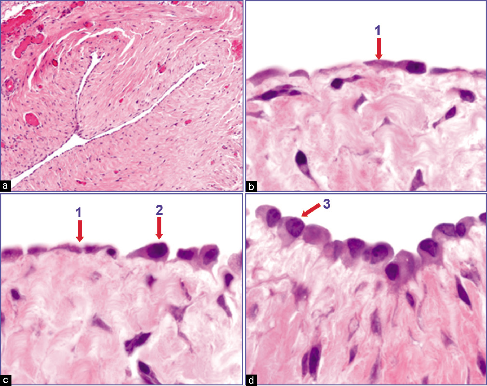 Histology of serous lining (inguinal hernia sac). The mesothelial cells lining the fibrous tissue are flat (1). Focal reactive changes are seen as hypertrophy of some cells, which assume a cuboidal contour (2,3). [a–d, HE stain (a, 10×; b–d, 100×).]