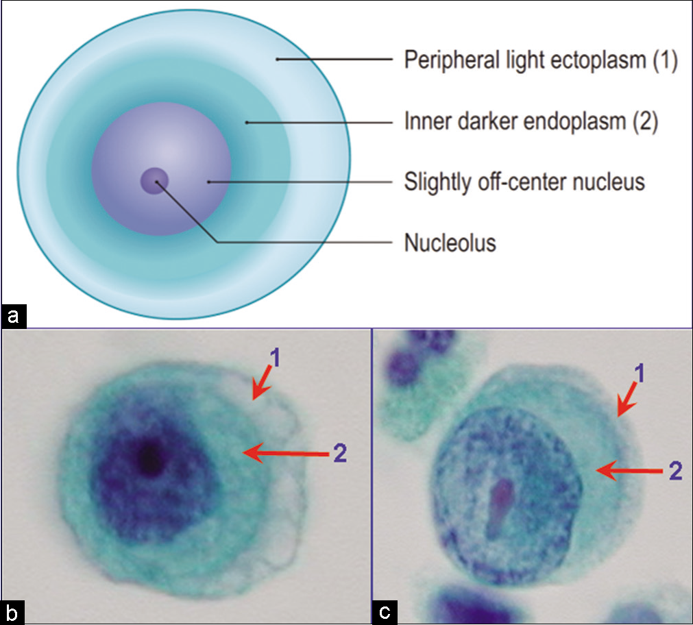 Mesothelial cells (peritoneal fluid): show outer faintly stained ectoplasm (1) with inner denser endoplasm (2) rich in intermediate filaments. The nucleus is usually central or near central (b), but may be eccentric (c). Nucleoli are readily observed. The vacuolation generally begins at the periphery in ectoplasm (1). [b,c, PAP-stained Autocyte Prep smear (b,c, 100× zoomed).]