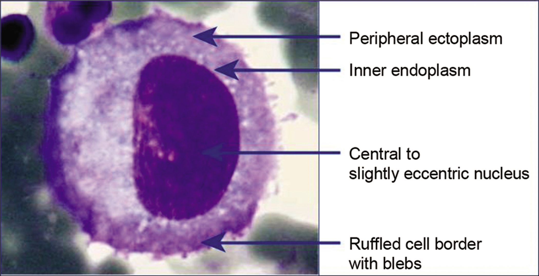 Mesothelial cell (pleural fluid): shows outer ectoplasm, which is denser than the inner endoplasm. The nucleus is central to slightly eccentric but not touching the cell periphery. The cell margin shows blebs and is ruffled. [DQ-stained Cytospin smear (100× zoomed).]