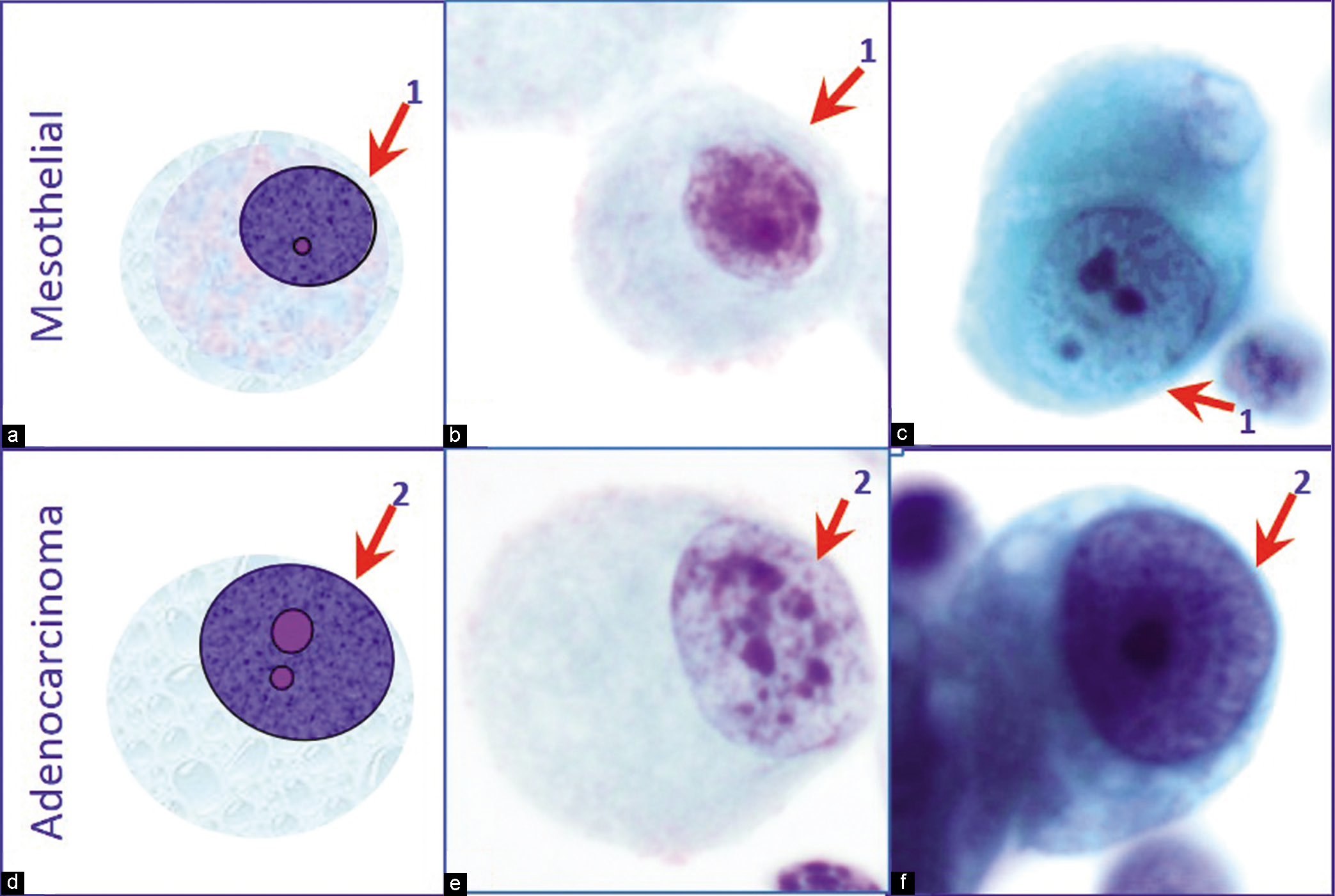 Mesothelial cells (a -c) versus adenocarcinoma cells (d -f) with eccentric nuclei. A thin rim between nuclear border and cell border (1) is seen in mesothelial cells. In comparison, the nuclear border in adenocarcinoma cells touches the cell border without a significant cytoplasmic rim (2). [PAP-stained Direct smear (b, e, 100× zoomed); PAP-stained SurePath Prep smear (c, f, 100× zoomed).]