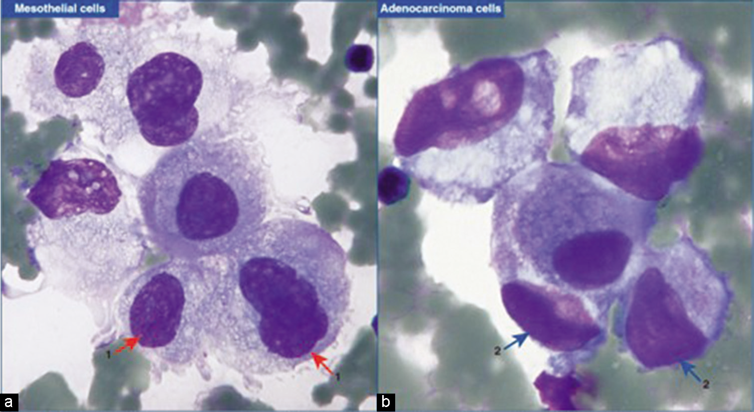 Mesothelial cells versus adenocarcinoma cells. (a) Mesothelial cells with central to eccentric nuclei. A thin cytoplasmic rim separates the nuclear border from the cell border (red arrow 1). (b) In comparison, the adenocarcinoma cells with eccentric nuclei appose the cell border (blue arrow 2). [a,b, DQ-stained Cytospin smear (a,b, 100× zoomed).]