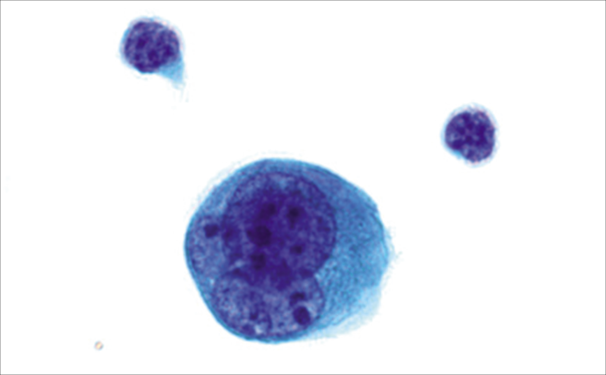 Multinucleated mesothelial cell: a mesothelial cell with three nuclei (arrows), which may vary in size. [PAP-stained SurePath Prep smear (100×).]