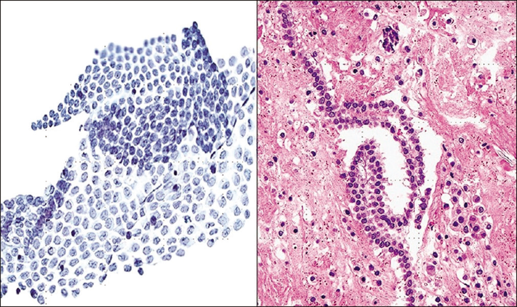 Monolayer of mesothelial cells in pelvic washings which may fold on itself (Pap stain, ×200). (Right) Strip of mesothelium seen as a “string of pearls” in a cell-block preparation (Cell-block section H and E, ×200).