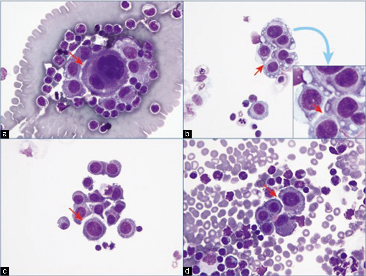 Mesothelial windows (arrows): reactive mesothelial cells, pleural fluid. [DQ-stained Cytospin smear (a–d 100μ; inset of b, 100× zoomed).]