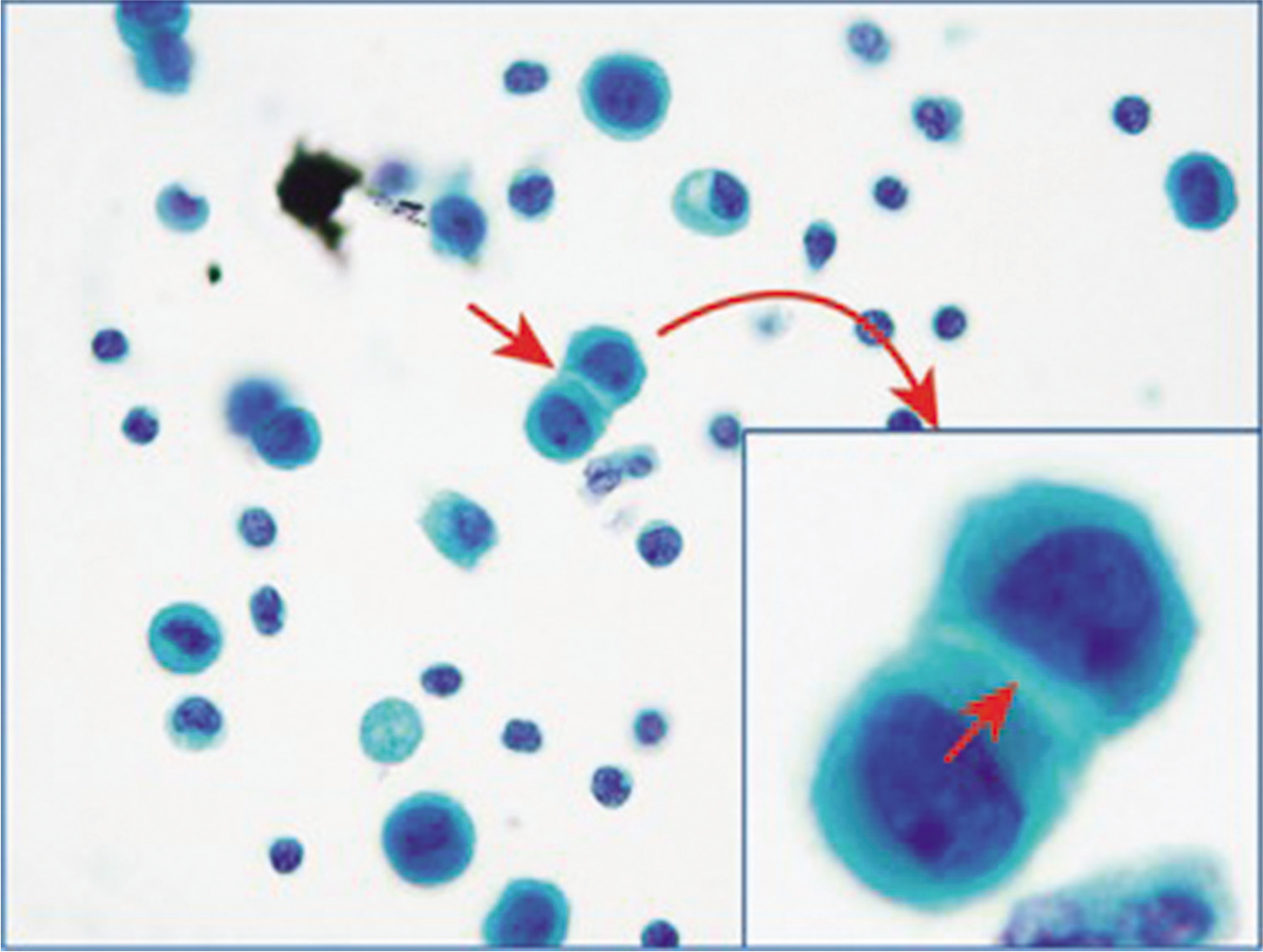 Mesothelial windows (arrows): reactive mesothelial cells, pleural fluid. [PAP-stained SurePath Prep (100×; inset, 100× zoomed).]