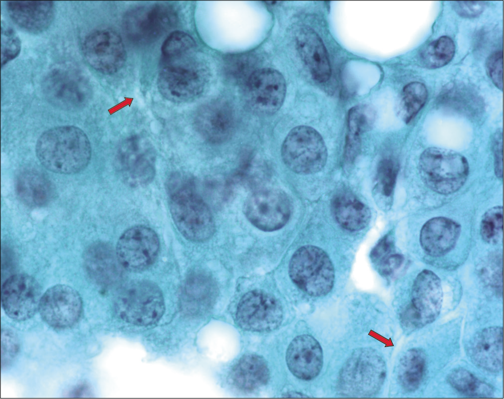 Monolayered flat sheet of mesothelial cells: may resemble squamous metaplastic cells. The spaces between mesothelial cells, mesothelial windows, are common (red arrows). Microvilli prevent the adjacent cells from apposing their cell borders with each other. Depending on many variables, the mesothelial windows may be subtle to very wide (peritoneal washing). [PAP-stained Cytospin smear (100×).]