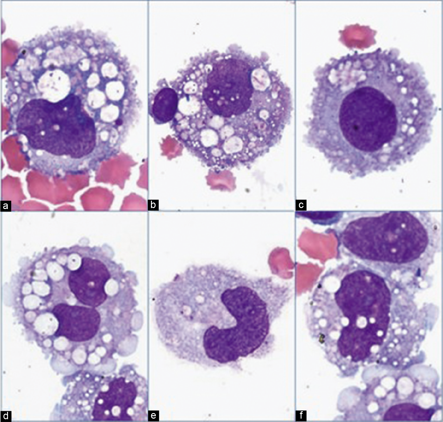 Macrophages: mesothelial and histiocytic macrophages show morphological overlap. a–d are morphologically suggestive of mesothelial macrophages; e and f favor histiocytic macrophages (pleural fluid). [a–f, DQ-stained Cytospin smear (100× zoomed).]