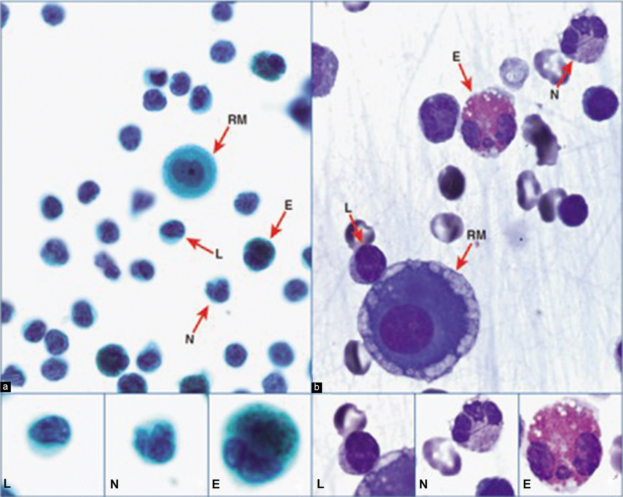 Reactive mesothelial cell (RM) with inflammatory cells: lymphocyte (L), neutrophil (N), and eosinophil (E) (pleural fluid). [a, PAP-stained SurePath Prep; b, DQ-stained Cytospin smear (a,b, 100×; L, N, E, 100× zoomed).]