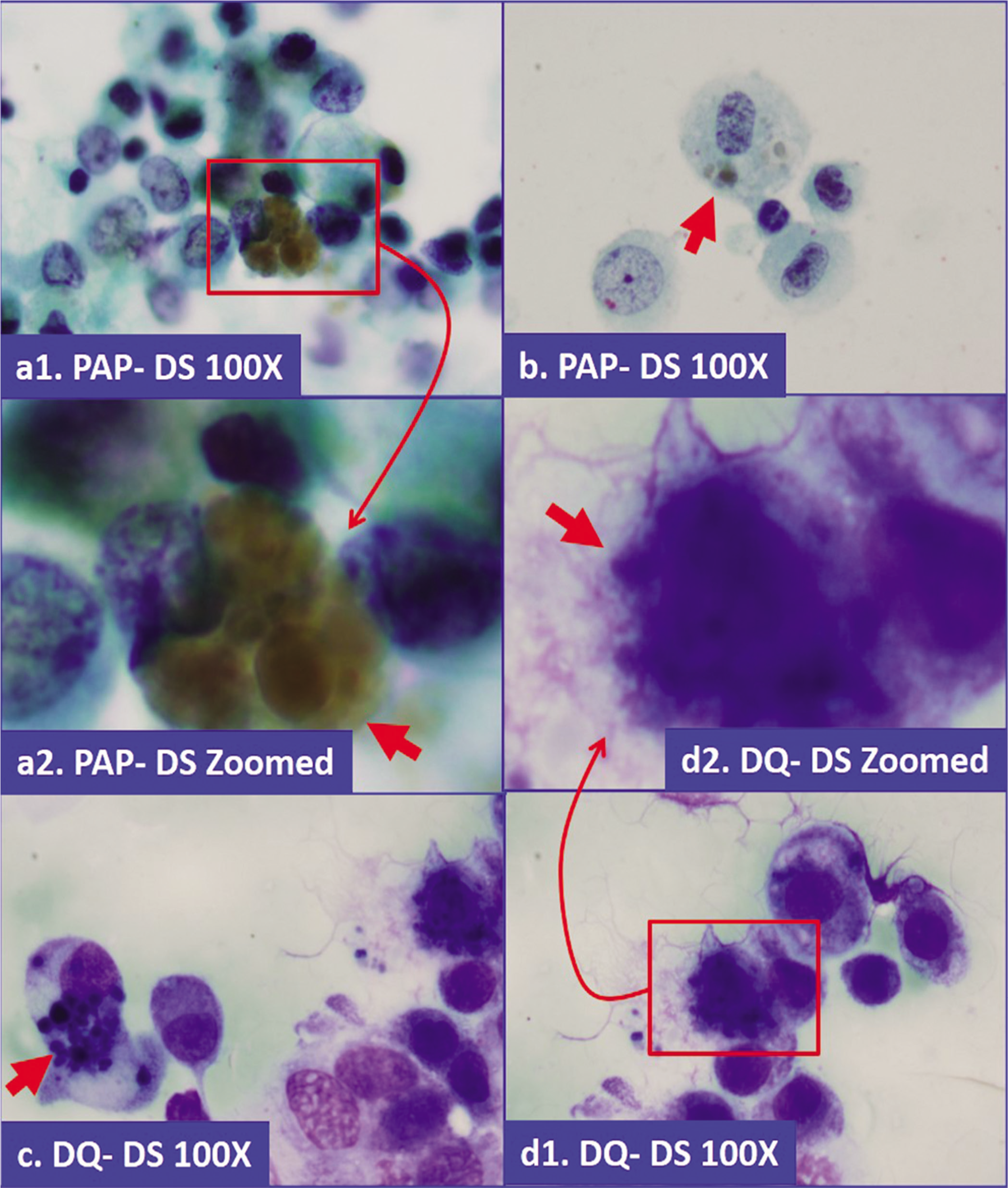 Hemosiderin in macrophages. Coarsely granular, brown pigment, which is blue-gray in Diff-Quick stained preparation (a,b: Papanicolaou stained direct smear; c,d: Diff-Quick stained direct smear).