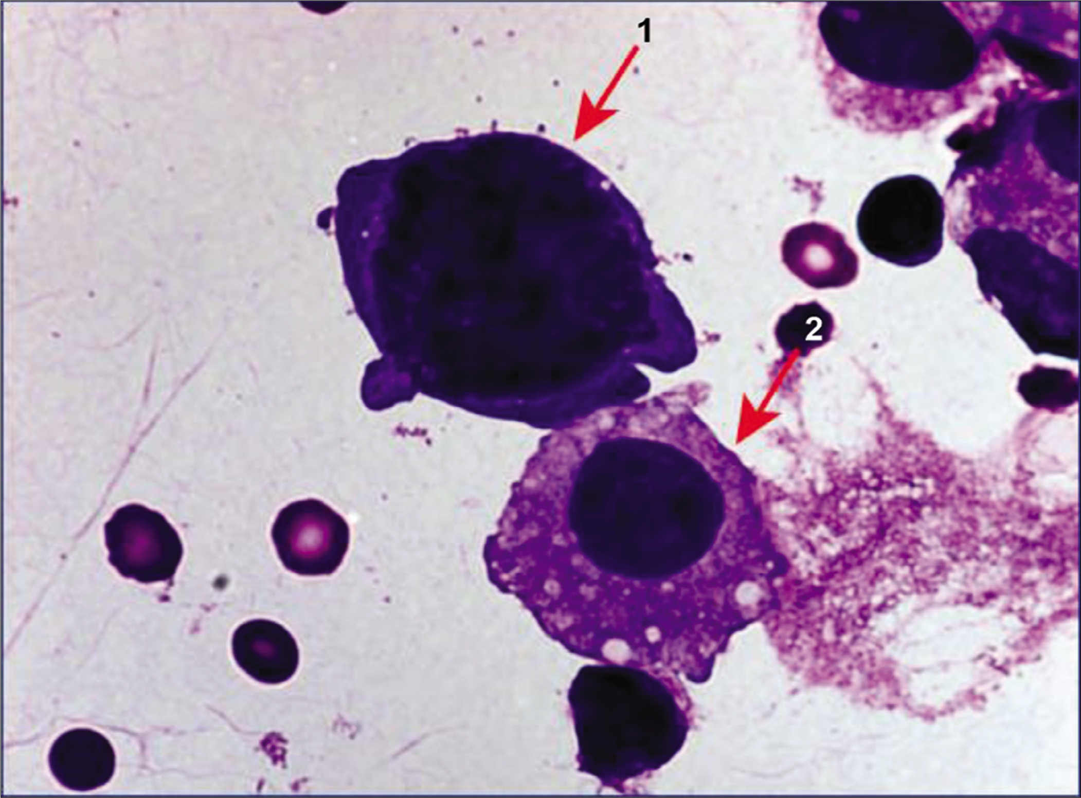 Megakaryocyte (1) with adjacent mesothelial cell (2) in hemorrhagic pleural fluid. [DQ-stained Cytospin smear, 100×].