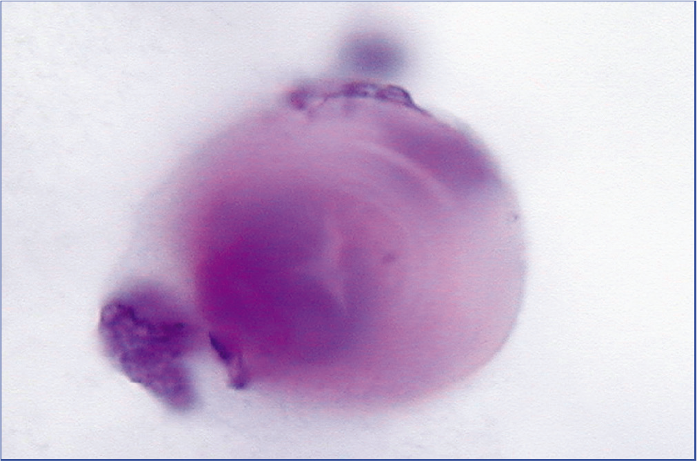 Psammoma body: round acellular bodies with concentric lamination (peritoneal fluid). [PAP-stained SurePath Prep (100× zoomed).]