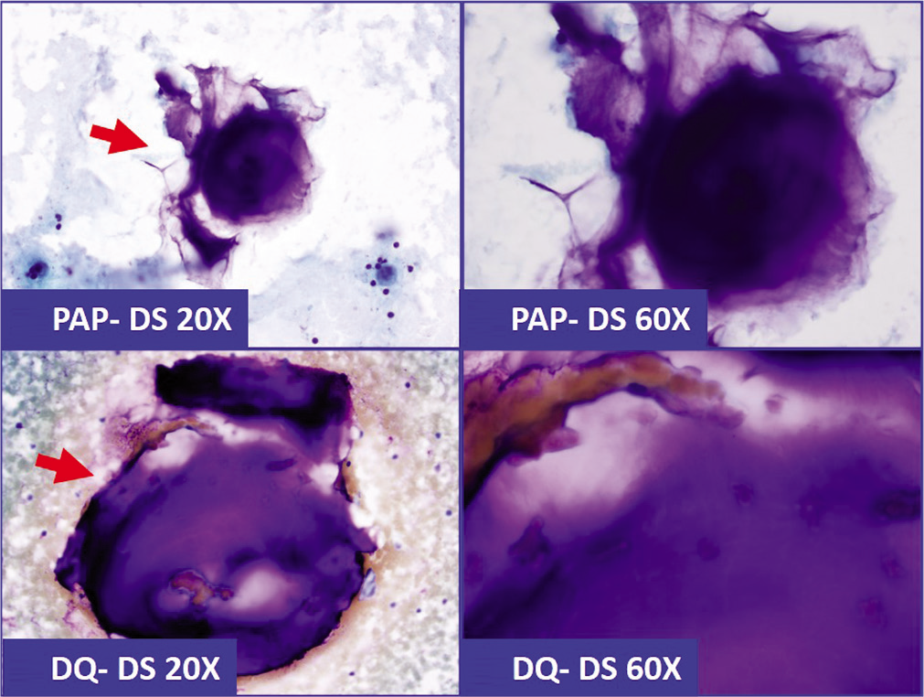 Because of superficial morphological resemblance, lubricant-debris (arrows) in effusion specimen could be confused with mucin (a&b: Pap stained direct smear; c&d: Diff-Quick stained direct smear). This pit-fall may deepen further with histochemical testing with positivity for Mucicarmin stain (c&d in Figure 20).