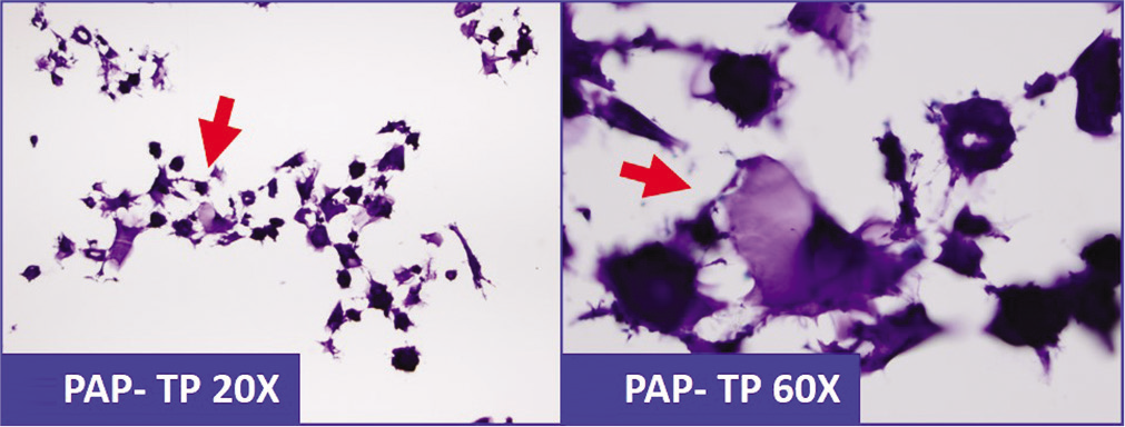 Abundant lubricant-debris (arrows) in peritoneal washing (should not be confused with mucin).