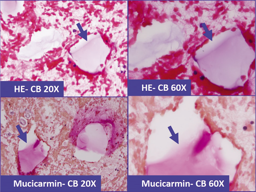 Lubricant-debris (arrows) in effusion specimen (a&b: HE stained cell-block section), which because of superficial morphological resemblance could be confused with mucin. This pitfall may deepen further with histochemical testing with positivity for Mucicarmin stain (c&d).