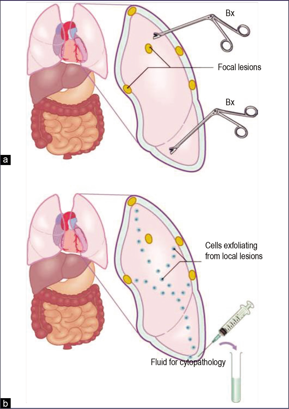 Sampling of pleural lesions: biopsy (a) versus effusion cytology (b). Focal lesions may be missed by biopsy. However, cells exfoliated from any of these focal lesions are pooled in the fluid and should be present in a related effusion or washing (Bx, biopsy).