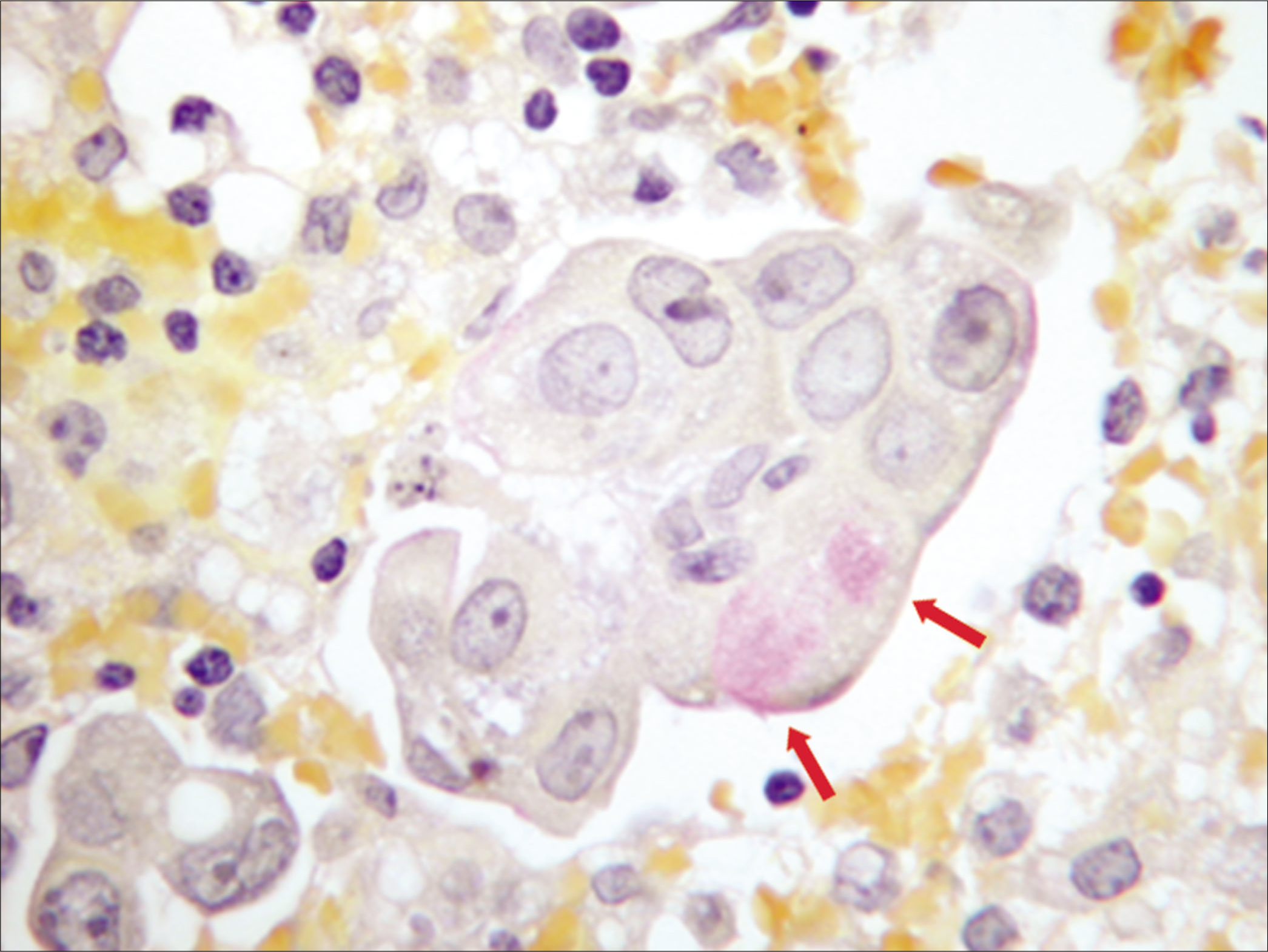 Mucicarmine stain: adenocarcinoma cells are mucicarmine positive (arrow) (peritoneal fluid). [cell-block section, 100×.]