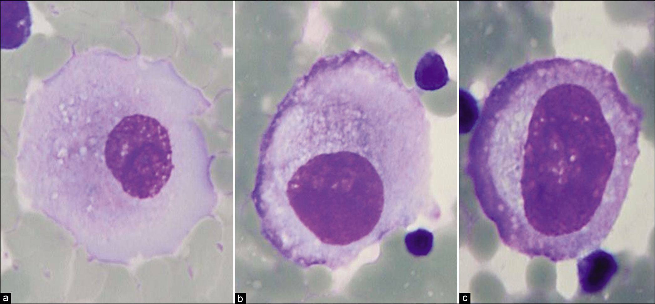 Mesothelial cells with central to slightly eccentric nuclei (ascitic fluid). The cytoplasm shows a two-zone staining pattern. For additional variations see also Figures 2,3,5. [a–c, DQ-stained Cytospin smear (a–c, 100X zoomed).]