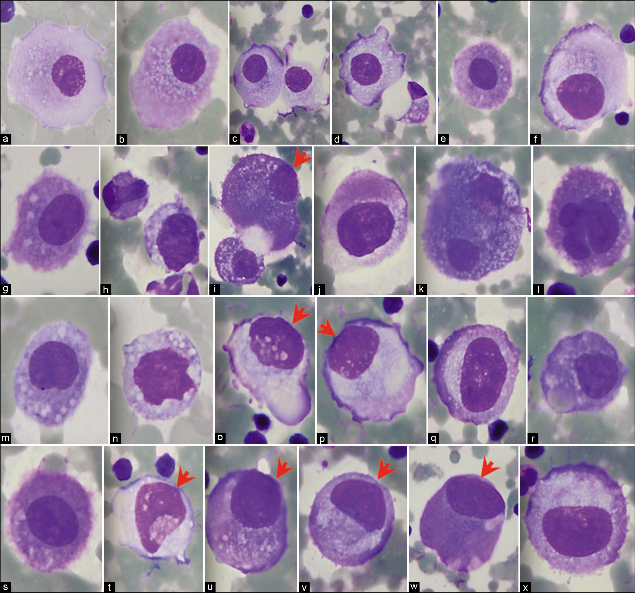 Panorama of mesothelial cells (ascitic fluid). Central to near central nuclei. Rare mesothelial cells may show eccentric nuclei touching the cell membrane, but usually there is a narrow rim of cytoplasm separating the nucleus from the cell border (arrowheads) [see also Figures 1,3,5]. [a–x, DQ-stained Cytospin smears (a–x, 100X zoomed).]