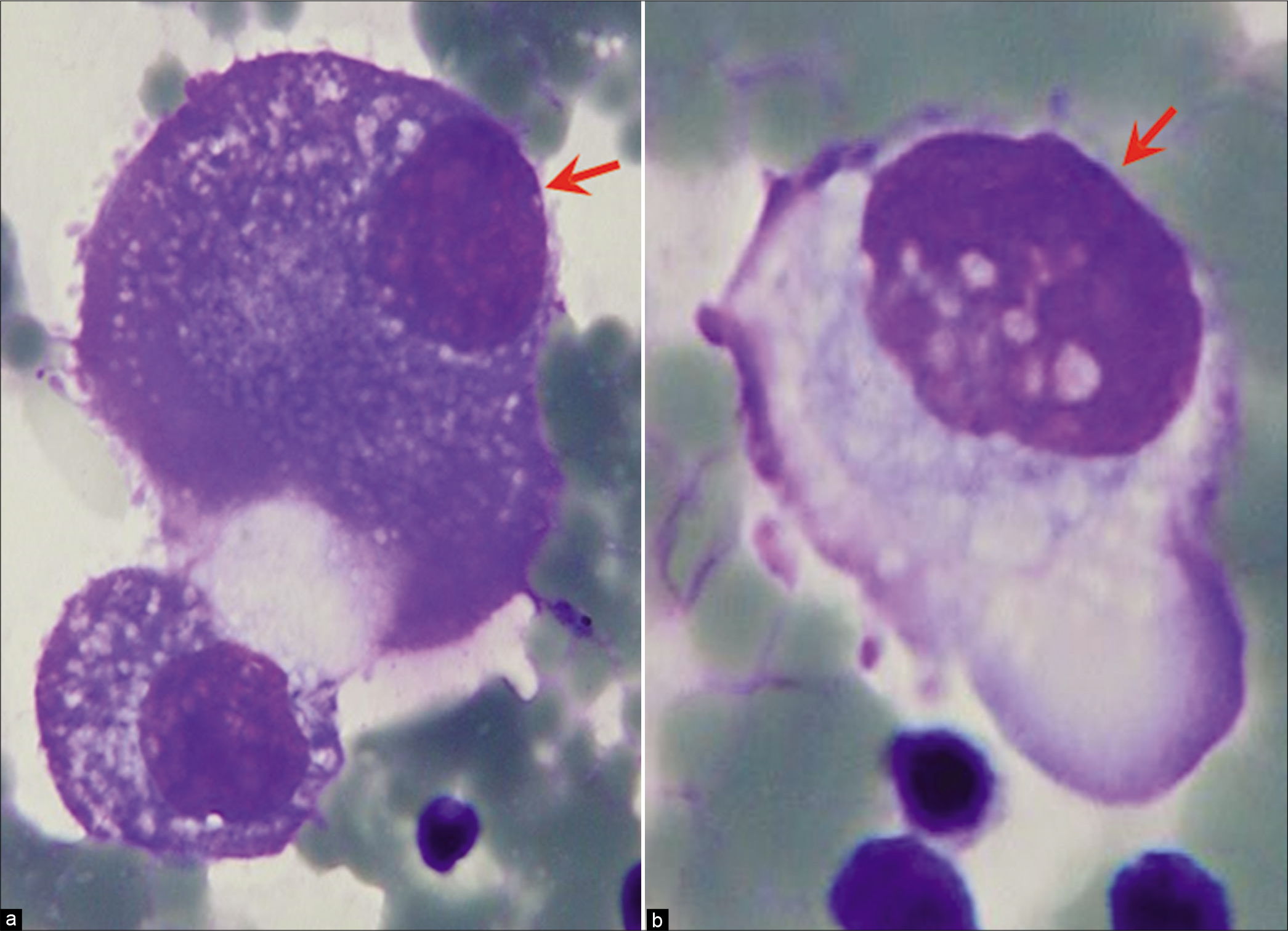 Mesothelial cells with eccentric nuclei (ascitic fluid) [see also Figures 2g,i,o,p,r,t,u,v,w]. Careful scrutiny usually shows a narrow rim of cytoplasm separating the nucleus from the cell border (arrows) with blebs [see also Figures 1,2,5]. [i,o, DQ-stained Cytospin smears (i,o,100X zoomed).]