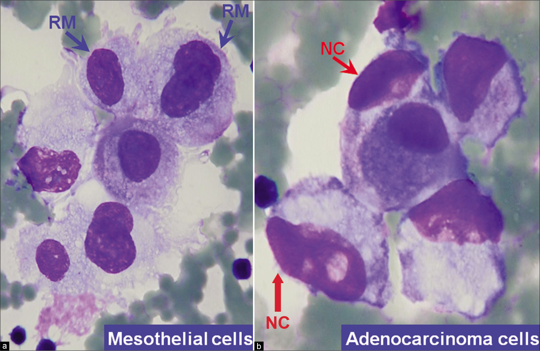 Mesothelial cells versus adenocarcinoma cells (ascitic fluid). a. Mesothelial cells with central to eccentric nuclei. A thin rim of cytoplasm separates the nuclear border from the cell border (blue arrows RM). b. Compared to mesothelial cells the adenocarcinoma cells with eccentric nuclei appose the cell border without a distinct rim of intervening cytoplasm (red arrows NC). [a,b, DQ-stained Cytospin smear (a,b, 100X zoomed).]