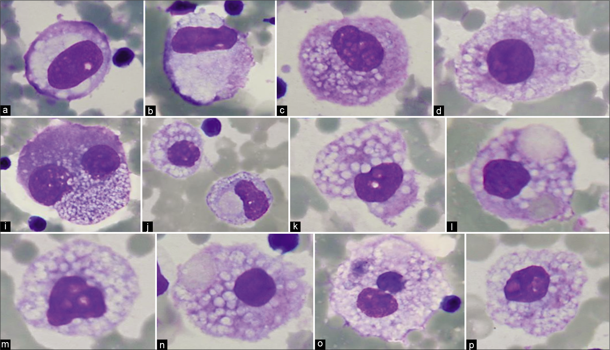 Vacuolated mesothelial cells with macrophage features (pleural fluid). Panorama of cytomorphologic features with central to slightly eccentric nuclei. [a–l, DQ-stained cytospin smears (a–l, 100X zoomed).]