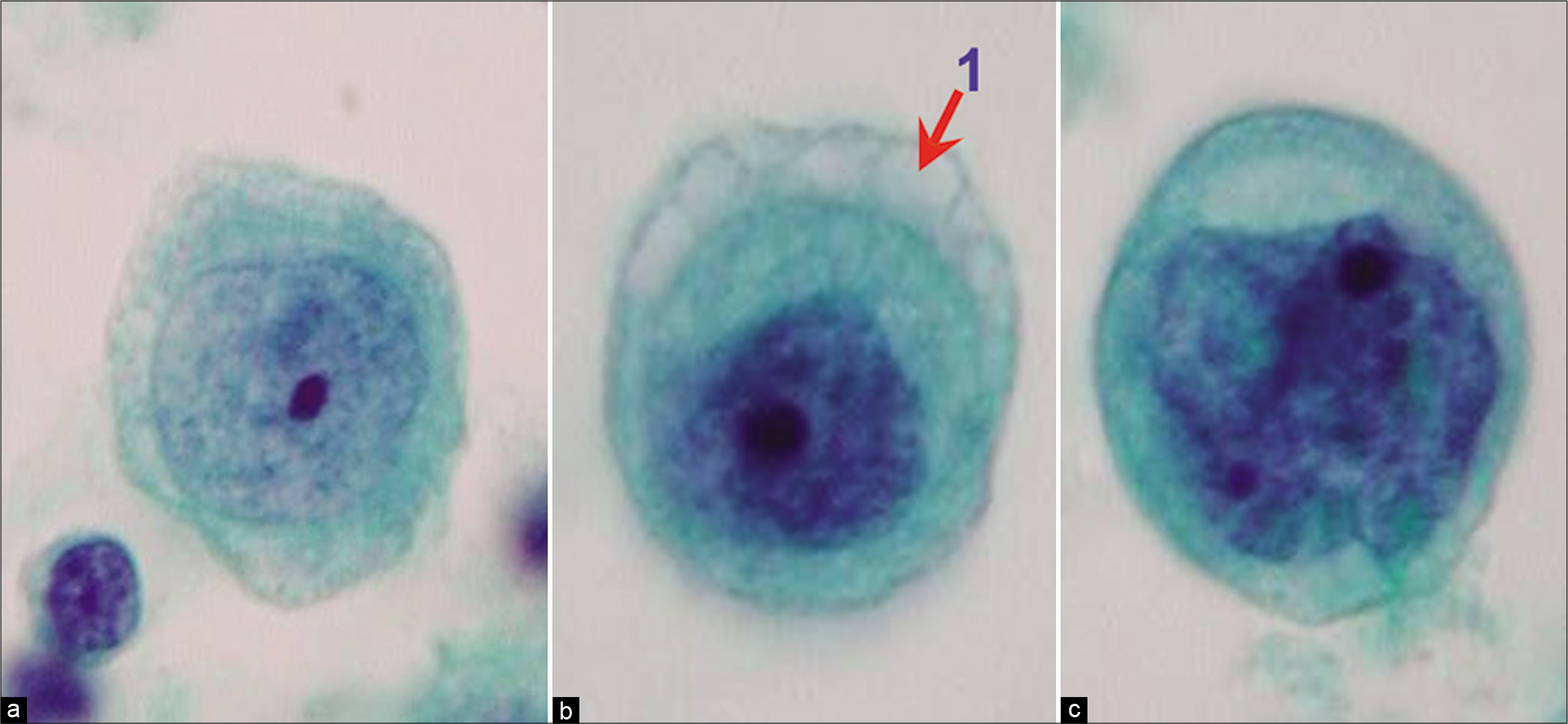 Mesothelial cells with central to slightly eccentric nuclei (ascitic fluid). The cytoplasm shows a two-zone staining pattern with peripheral vacuolation (red arrow 1). For additional ranges see also Figures 7, 8, and 10. [a–c, PAP-stained ThinPrep smear (a–c, 100X zoomed).]