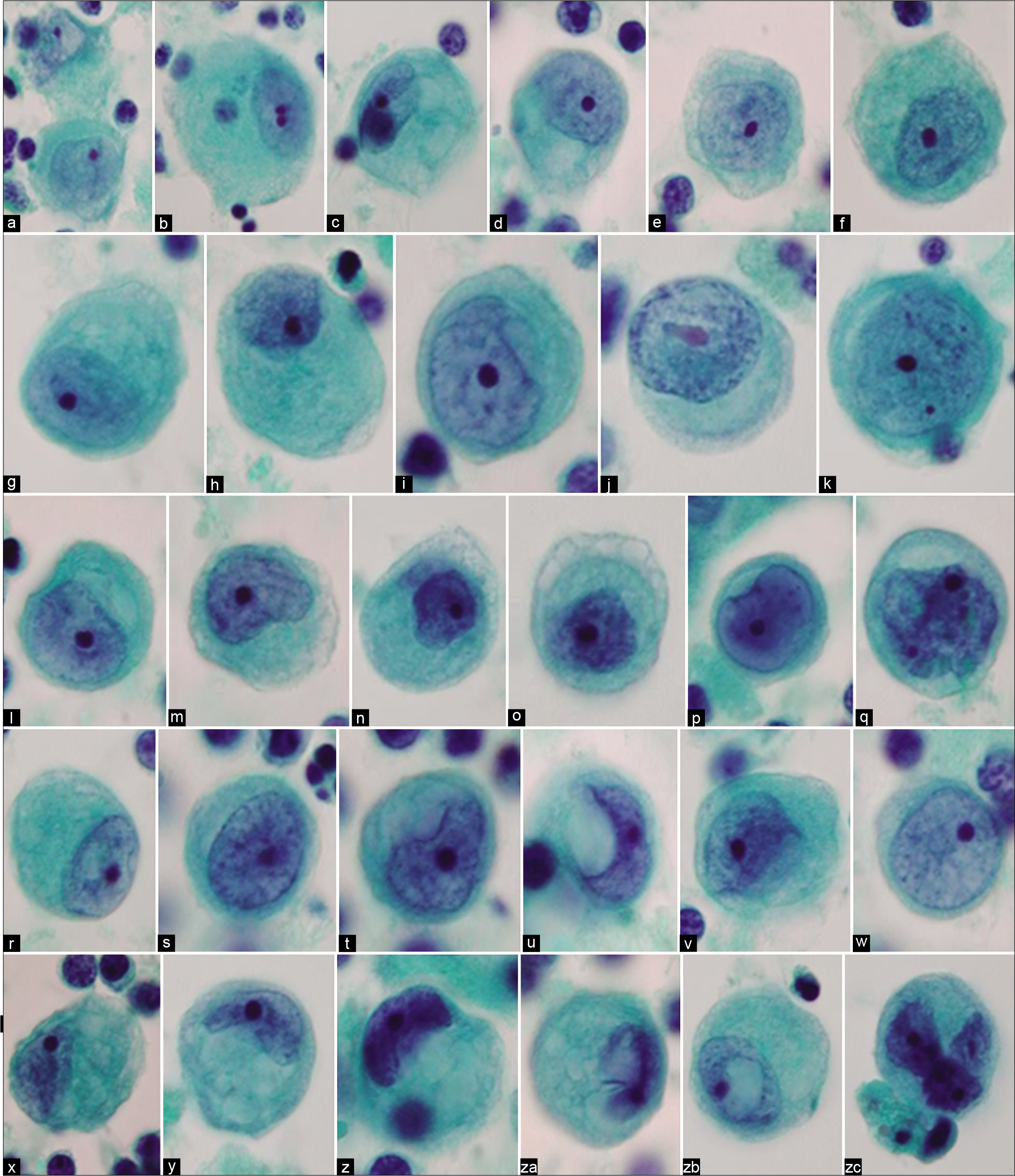 Mesothelial cells with central to eccentric nuclei (ascitic fluid). Spectrum of cytomorphologic features. [a–zc, PAP-stained ThinPrep smear (a–zc, 100X zoomed).]