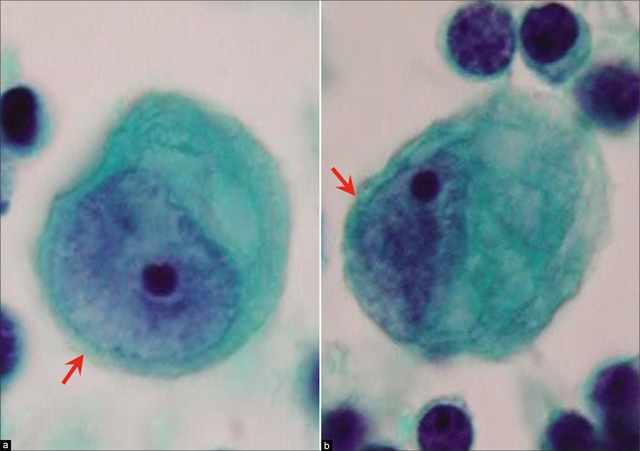 Mesothelial cells with eccentric nuclei (ascitic fluid); [see more cells in Figure 7b,d,g,h,i,j,m, etc.]. Careful scrutiny usually shows a narrow rim of cytoplasm separating the nucleus from the cell border (arrows). [l,x, PAP-stained ThinPrep smear (100X zoomed).]