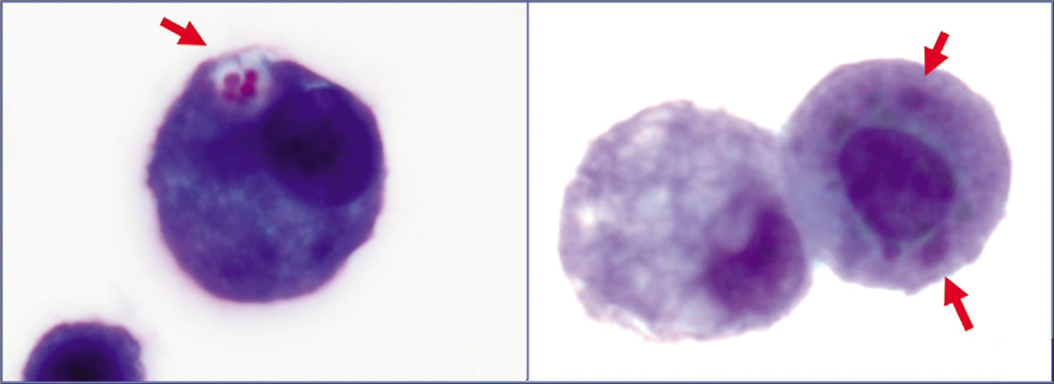 Mesothelial cells with phagocytosed erythrocyte (red arrow in a) and hemosiderin (red arrows in b) [a–b, PAP-stained ThinPrep (X100 oil, zoomed)]