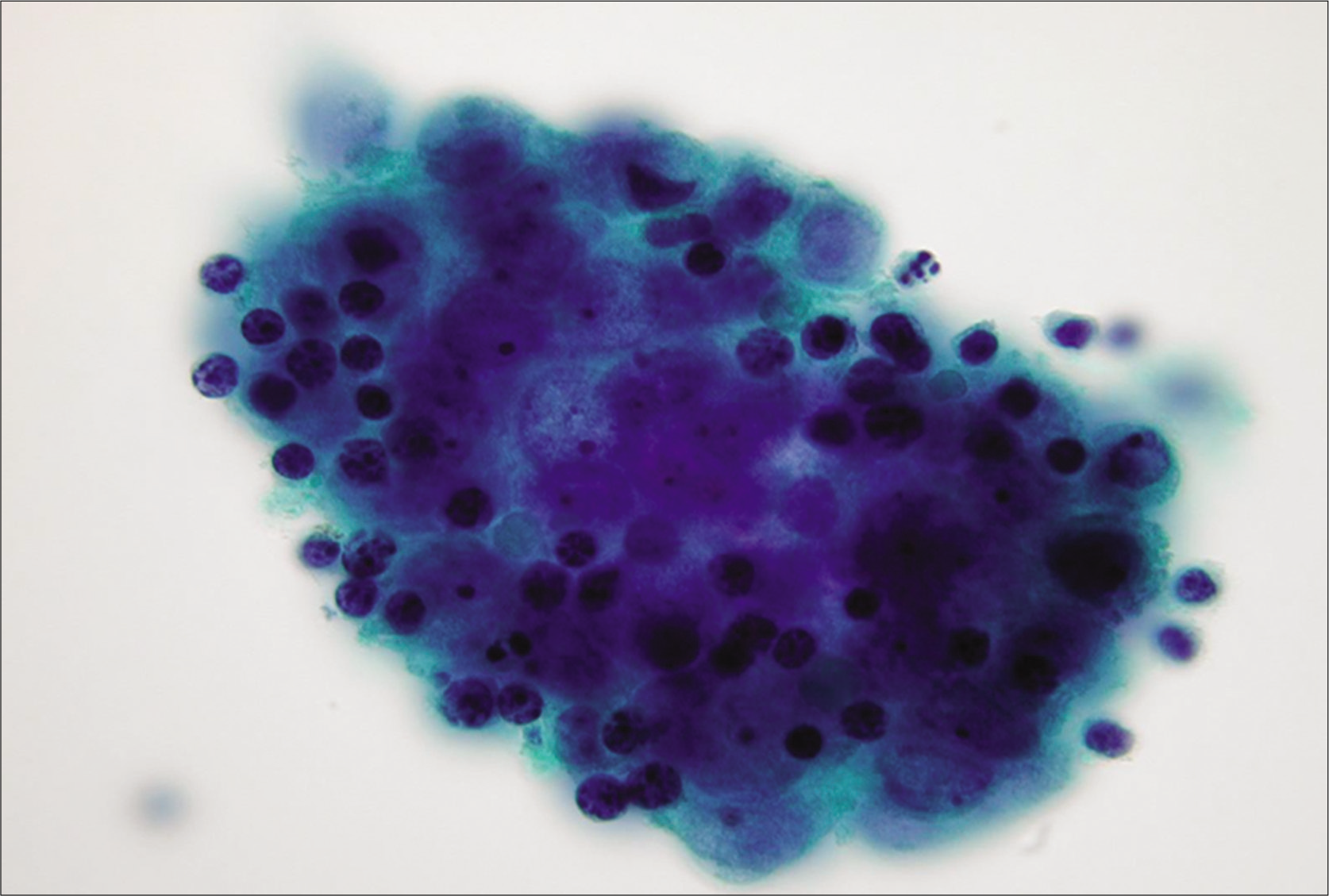 Reactive mesothelial cells in clusters mixed with chronic inflammatory cells, mostly mature lymphocytes (ascitic fluid). This consult case was initially misinterpreted as positive for malignant cells. Extensive search for the primary was negative [see also Figures 10, 11]. [PAP-stained ThinPrep smear (X100 oil, zoomed.)]