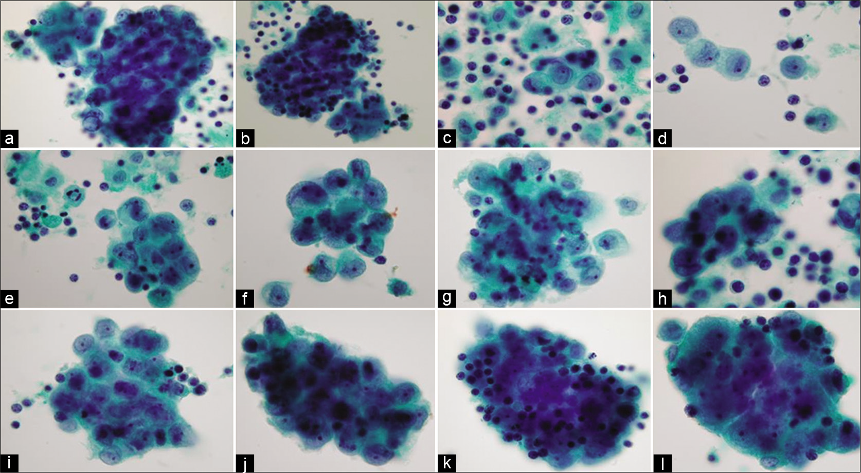 Reactive mesothelial cells in clusters (ascitic fluid), mixed with chronic inflammatory cells within the groups and between the mesothelial cells in the background [see also Figures 9, 11]. [PAP-stained ThinPrep smear (X100 oil, zoomed).]