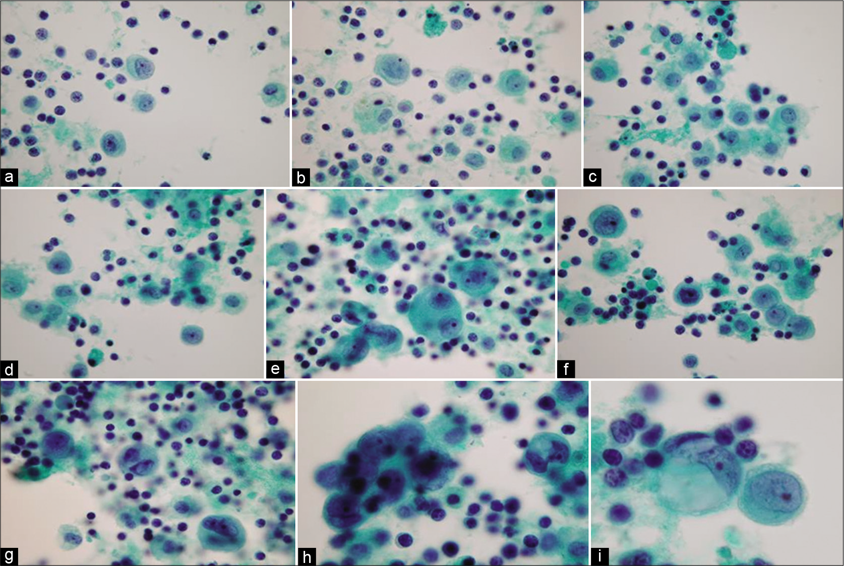 Reactive mesothelial cells mixed with chronic inflammatory cells (ascitic fluid). Mesothelial cells are present as isolated cells and as small groups [see also Figures 9, 10]. [PAP-stained ThinPrep smear (100X zoomed).]