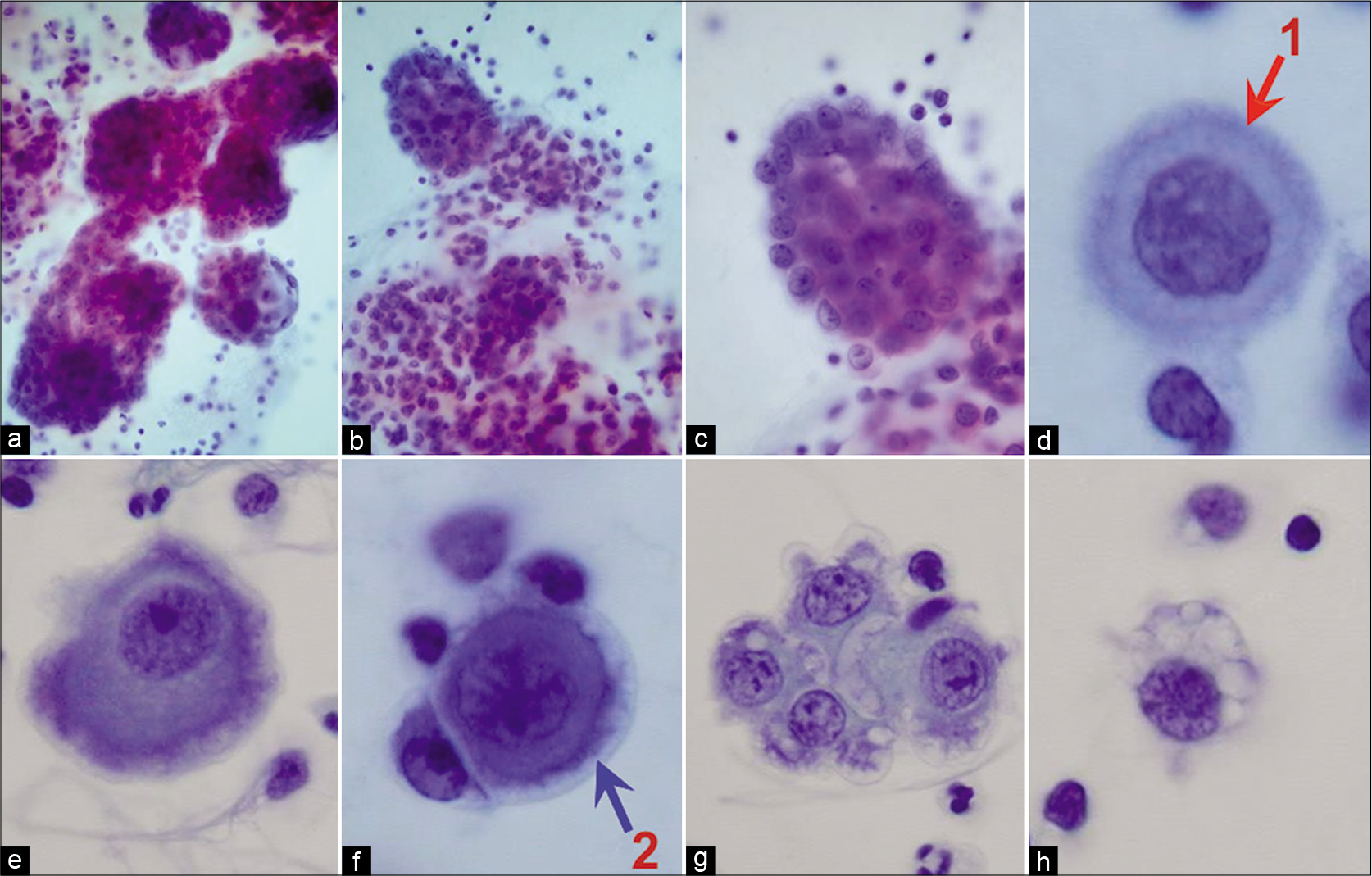 Malignant epithelioid mesothelioma (pleural fluid). Mesothelioma cells show numerous large three-dimensional groups of cells. The individual mesothelioma cells do not show any significant variation from reactive mesothelial cells without remarkable features of malignancy. The mesothelioma cells, like reactive mesothelial cells, show two-zone staining (red arrow 1) with peripheral vacuolation (blue arrow 2). [a–h, PAP-stained ThinPrep smear (a,b, 20X; c, 100X; d -h, 100X zoomed).]