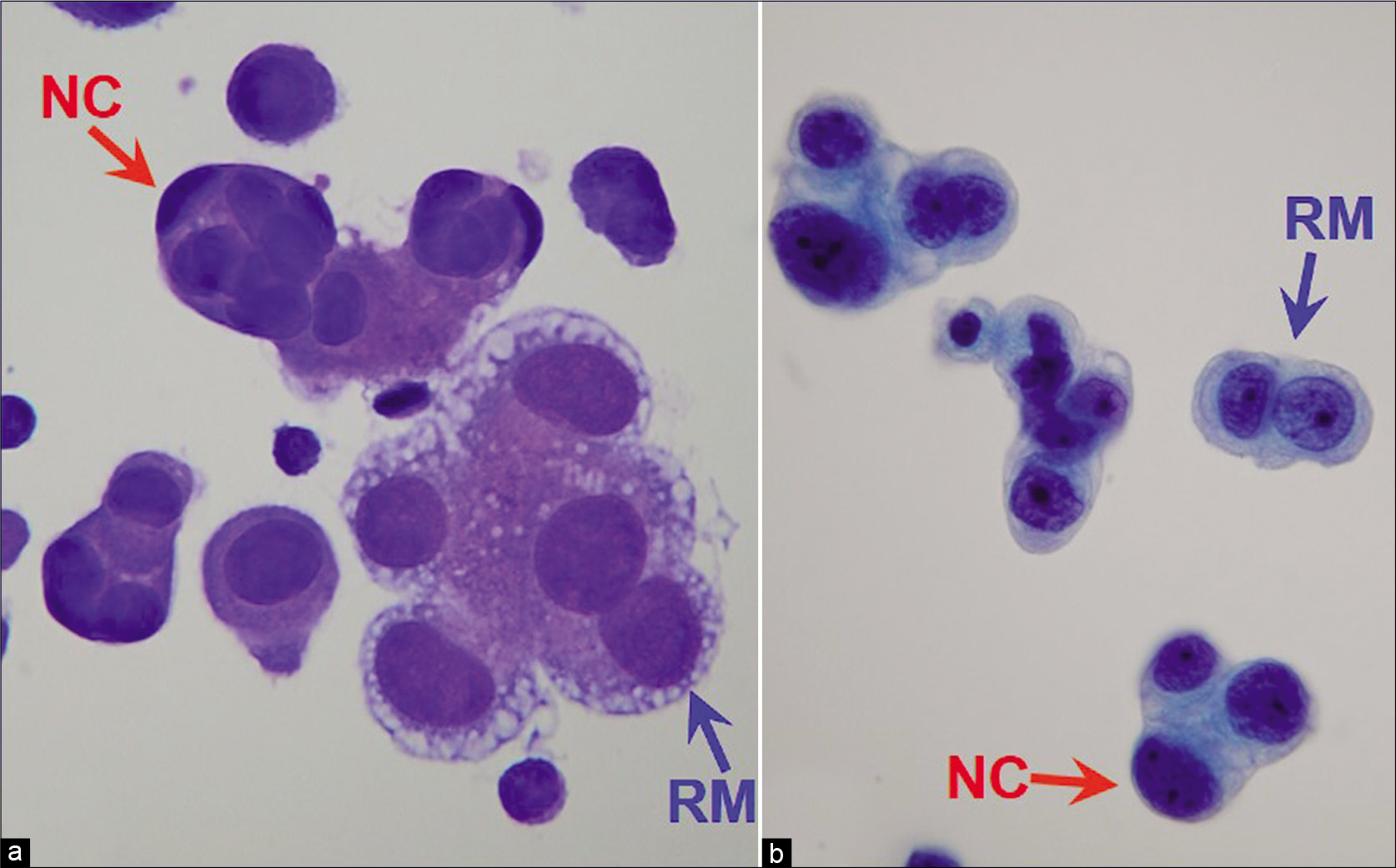 Metastatic adenocarcinoma with a two-cell population (ascitic fluid). Blue arrow RM highlights reactive mesothelial cells (central nuclei, peripheral vacuolation, community borders of cell groups formed by cell membrane) and red arrow NC highlights neoplastic cells of adenocarcinoma (eccentric nuclei touching the cell membranes without any rim of cytoplasm between the nucleus and cell membrane; the community border of cell groups is formed by mostly nuclear contours). [a, DQ-stained Cytospin smear; b, PAP-stained ThinPrep smear (a,b, X100 oil, zoomed).]