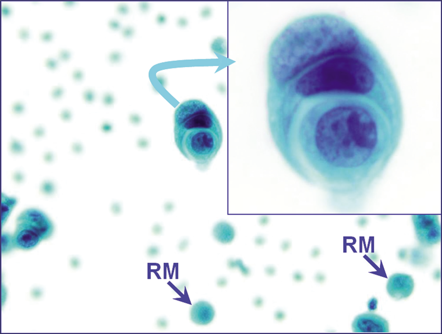 The cell-in-cell pattern of neoplastic cells (metastatic mammary carcinoma, pleural fluid). A similar pattern may also be observed in reactive mesothelial cells. In this case, the morphology of these cells resembled other cancer cells seen as a second population without overlap with nuclear morphology of reactive mesothelial cells (blue arrows RM). [PAP-stained ThinPrep smear (X100 oil; inset, zoomed)].